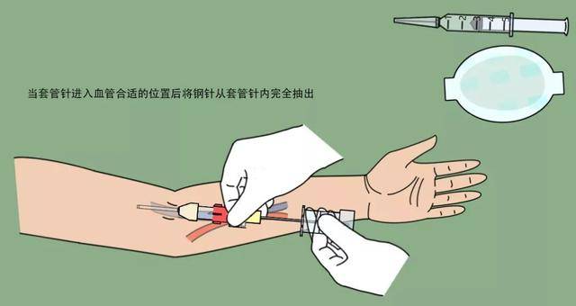 操作流程丨透析用留置针在血液净化中的标准化使用流程