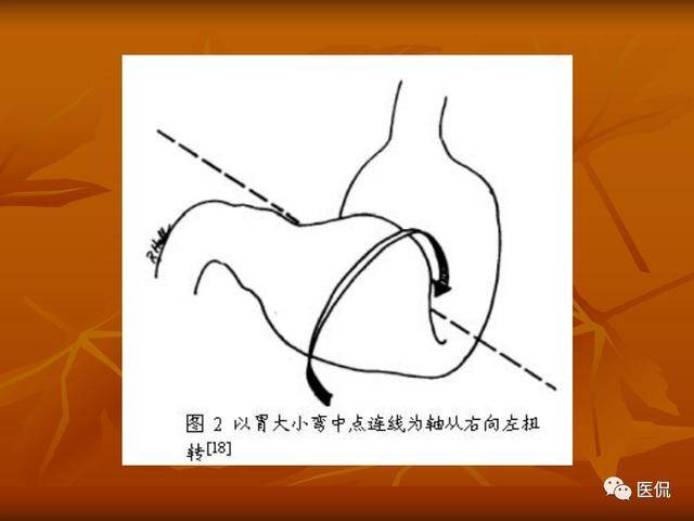 胃扭转的x线诊断与鉴别诊断 医学影像经典ppt