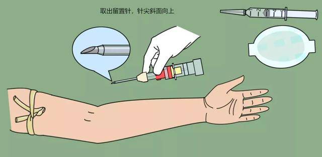 操作流程丨透析用留置针在血液净化中的标准化使用流程
