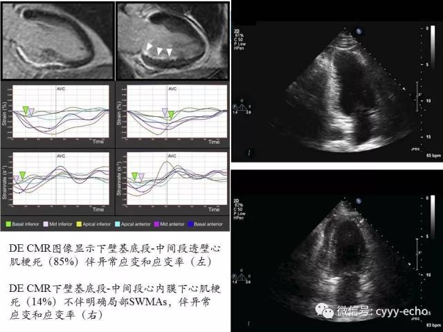 视觉评估收缩期室壁运动异常联合斑点追踪超声心动图有助于心肌梗死的