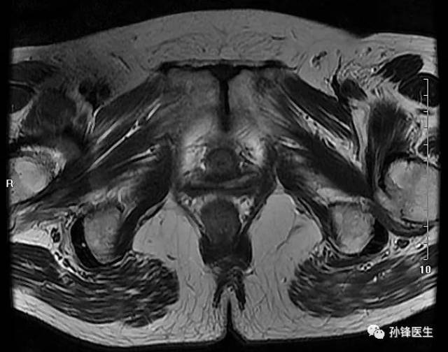 医学笔记|锋哥教你读盆腔核磁共振(4):经女性耻骨联合