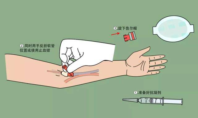 操作流程丨透析用留置针在血液净化中的标准化使用流程