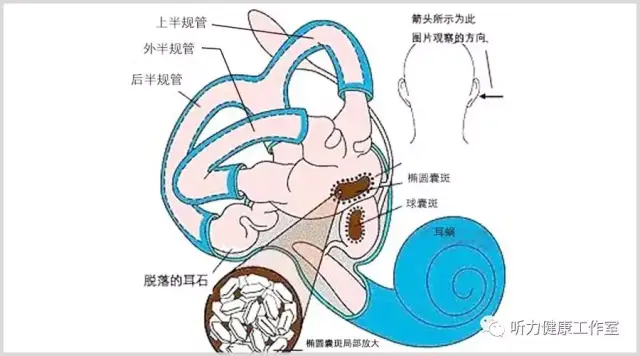 耳石症:耳朵里的石头掉下来了,晕得不得了,怎么办?