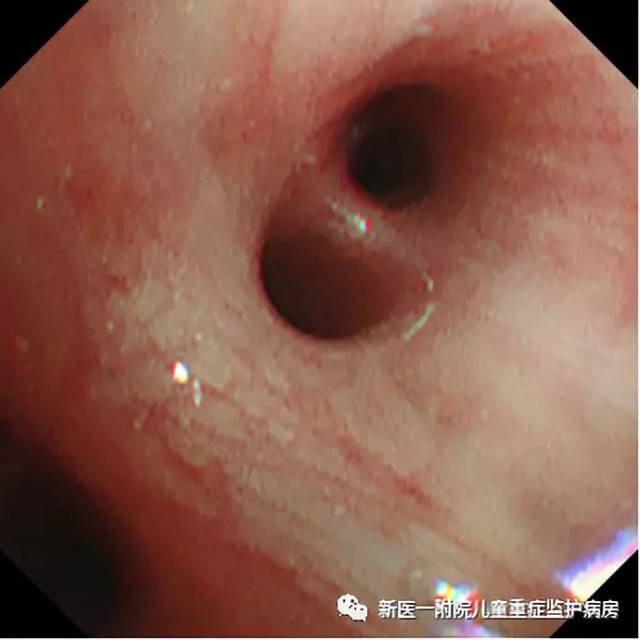 picu电子纤维支气管镜辅助治疗小儿重症肺炎功劳大