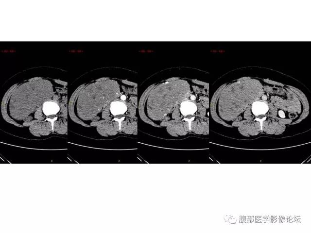 【腹膜后肿物(十二指肠水平部)】胃肠道间质瘤