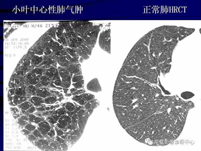 带你了解肺气肿的影像学分型及诊断
