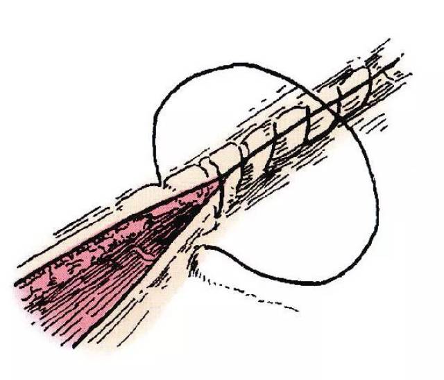 缝合在切口一端开始,应用连续水平褥式缝合平行切口进针,缝针刺入