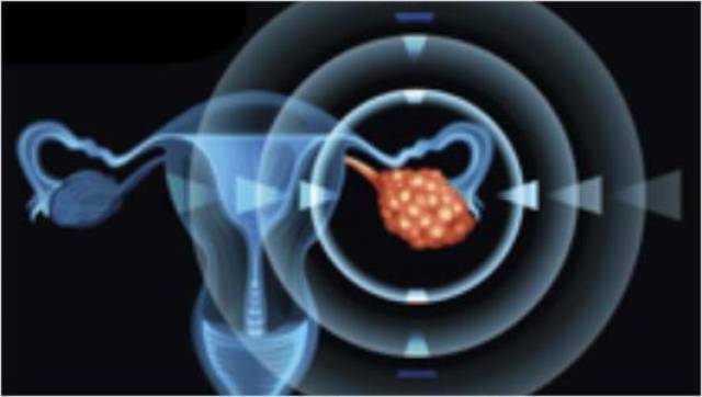“妇癌之王”治疗又添新武器 ,卵巢癌靶向新药登陆香港,内地上市申请已获受理