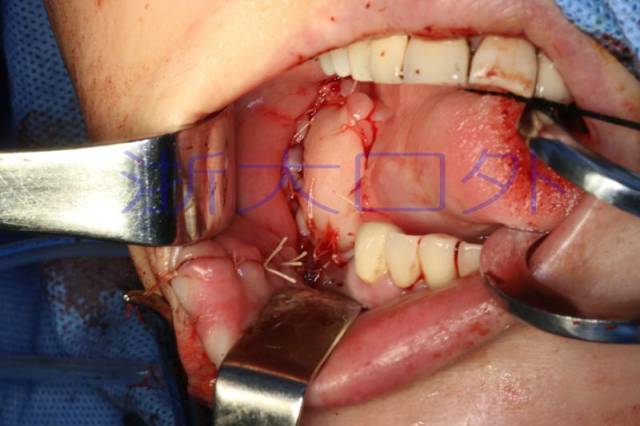我院成功开展一例颏下岛状皮瓣修复口腔颌面部组织缺损手术