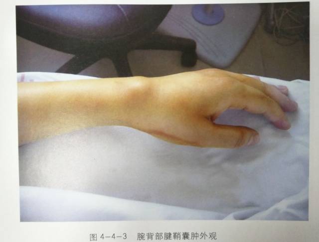 手部腱鞘囊肿比腕部少见,米粒大小,位于掌侧远横纹下或近节指间关节