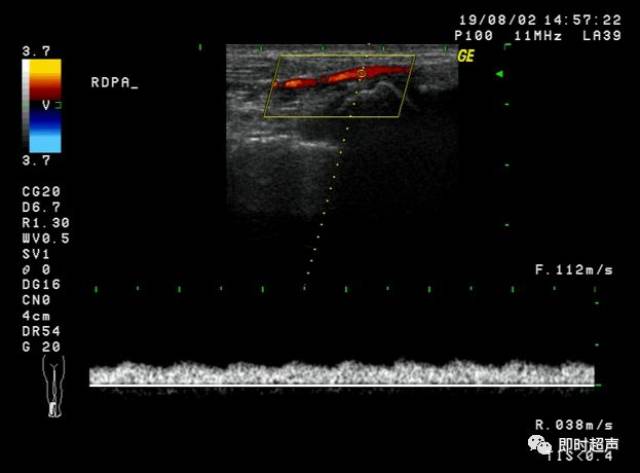 下肢血管超声检查及诊断思路(上)