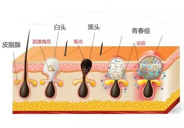 如果毛孔开口较大,脂栓外部 被氧化,就会变黑变硬,形成黑头