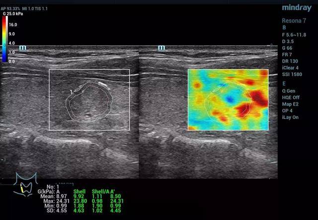 甲状腺乳头状癌病例(2 实时二维剪切波弹性成像的评估应用 本次大会