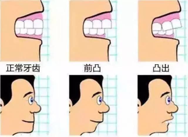 借助拔牙间隙收缩前牙,改善牙弓突度,改善面型.