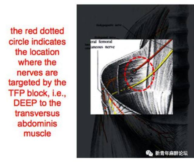 实用教程|超声引导下腹横筋膜(tfp)阻滞