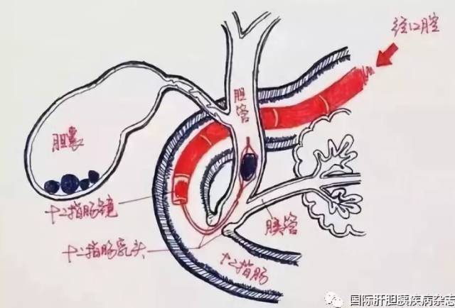 hepatobiliarypancreatdisint丨胰胆管隔膜切开针刀开窗术及两者联合