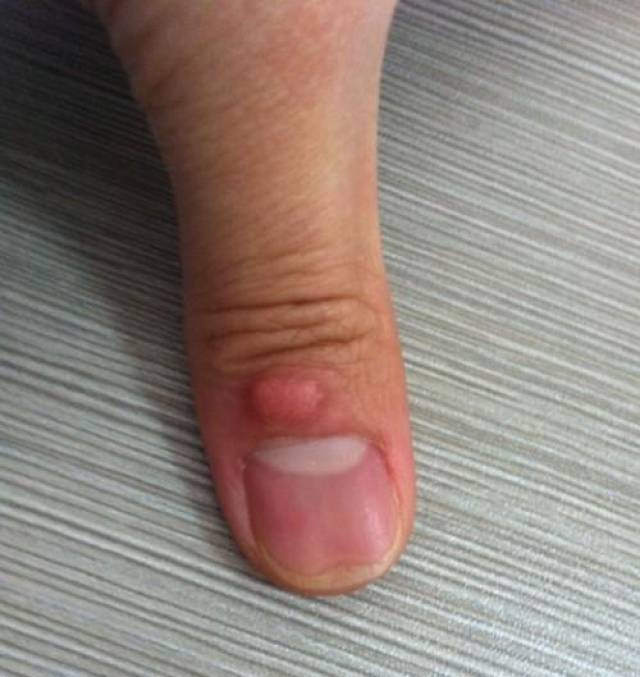五个手指不同的疤痕 所代表的不同含义你知道吗_手机搜狐网