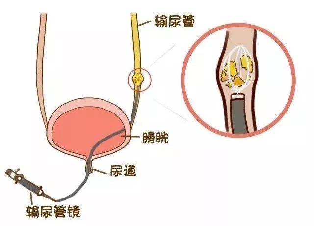 在输尿管上段的结石用输尿管软镜下碎石(如左图);输尿管中下段结石则