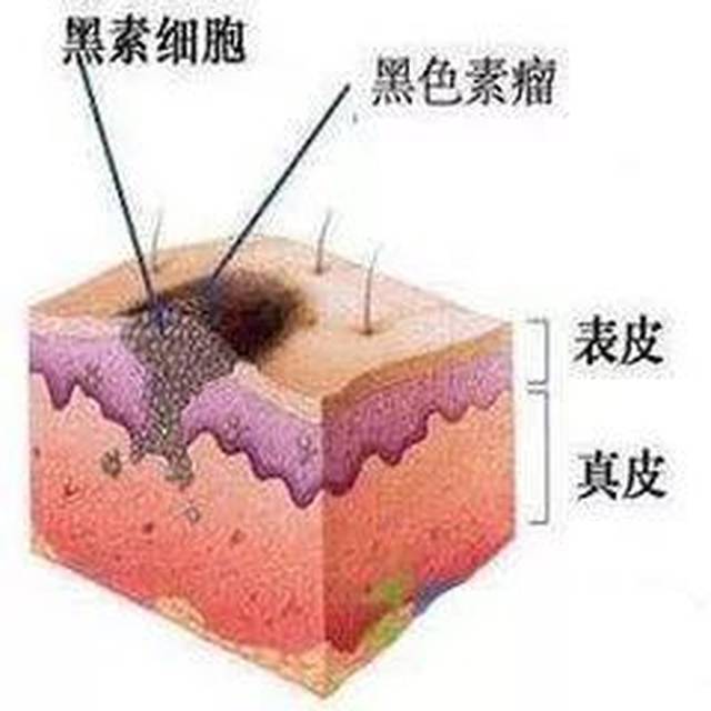 警惕!身上有这些特征的痣存在恶变风险,你身上有吗?