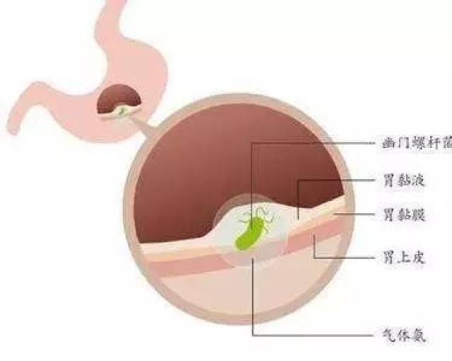 这是关于幽门螺杆菌(hp)的最全科普请收好