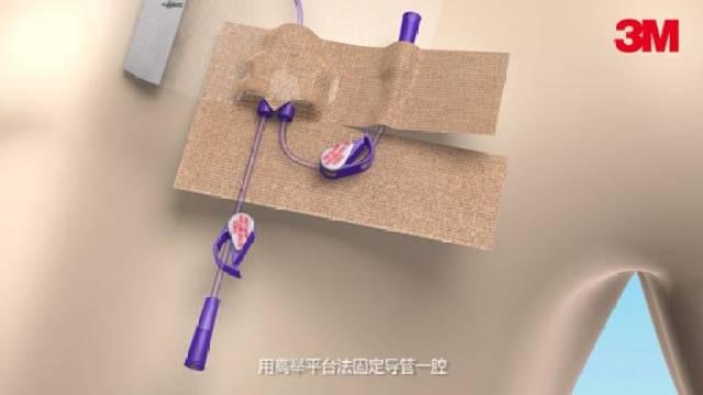 第3步:撕除一条离型纸,高举平台法固定一腔,注意胶带无张力粘贴在