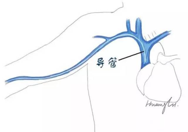 picc的优点