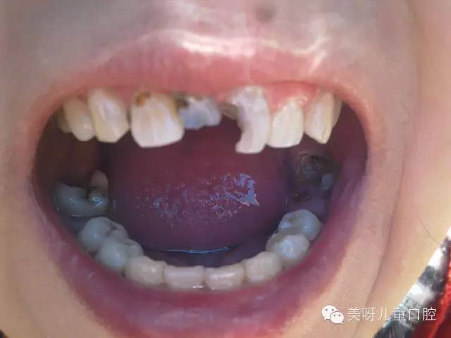 龋齿俗称蛀牙或虫牙,是由于食物残渣在牙缝中发酵,产生酸类,从而破坏