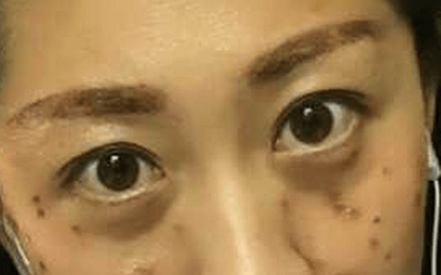 爱丽丝的秘密-你了解你的色斑嘛?