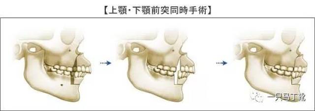 就像这张图,上下颌骨前突严重,需要把骨头锯开做正颌,还是很可怕