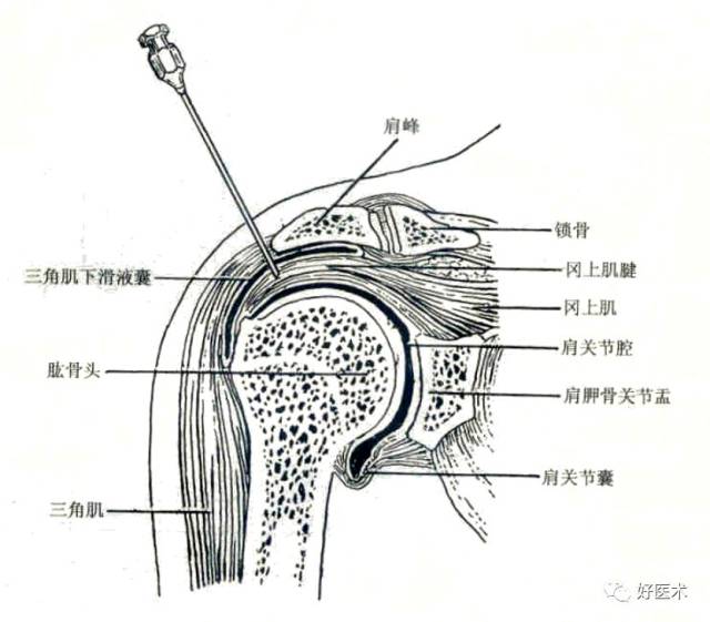 常用关节腔穿刺方法技巧大全,都在这里了!