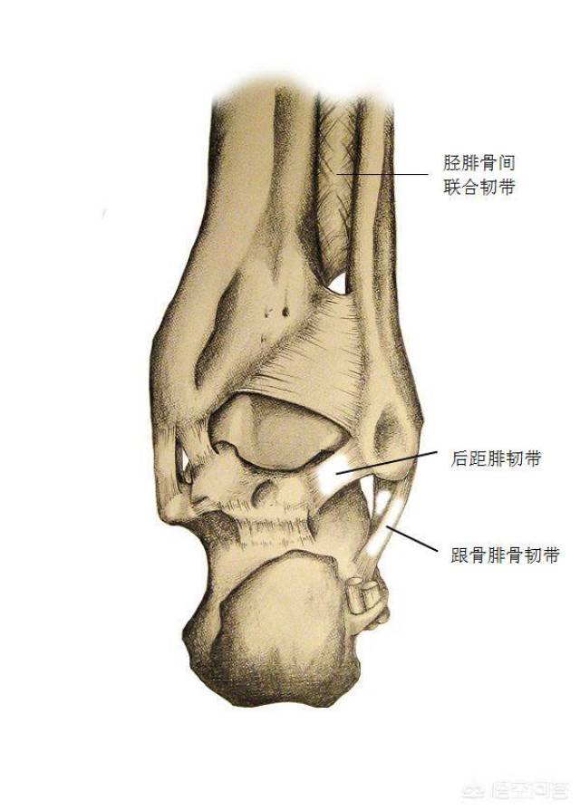 有时候,后侧的后距骨腓骨韧带和胫腓骨间的联合韧带会被撕裂,称为高位
