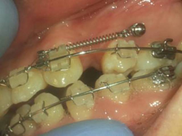 牙齿矫正为什么要打支抗钉,这个"小钉子"究竟有啥作用?