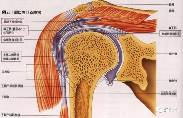 三 肩关节腔穿刺法 肩关节周围炎的原因与病变 肩峰下滑液囊,肩关节