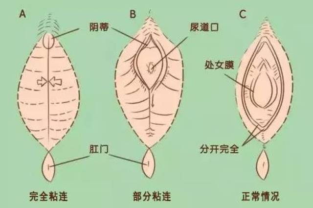 注意:千万别手贱强行扒开,反而会造成伤害.