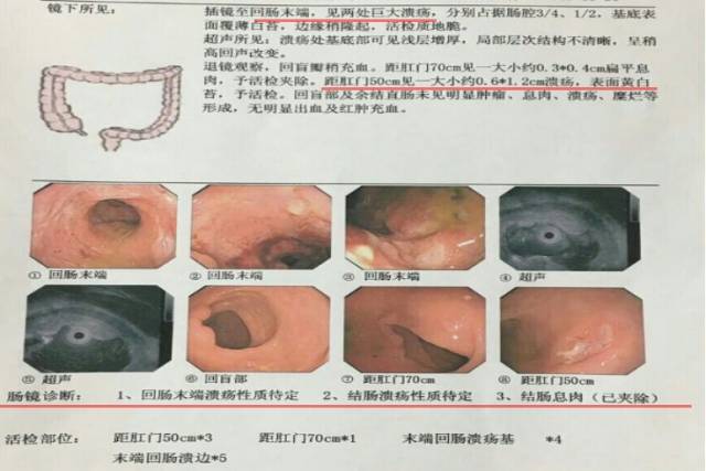 肠镜病理显示:回肠末端炎症坏死,伴黏膜淋巴组织增生.