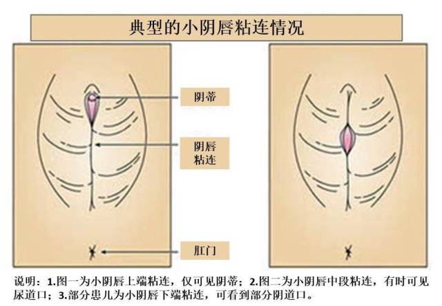轻度粘连:指小阴唇上部,中间或下部粘连,阴道口和/或尿道口不能完全