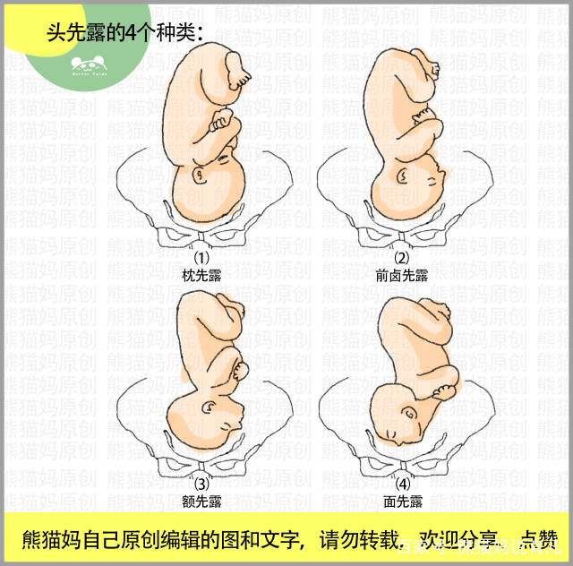 胎位不正11类型图:头先露,臀先露,横产式,斜产式,宝妈