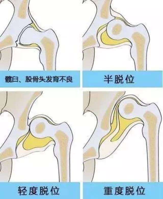 当心!宝宝腿上褶子不对称,骨骼发育或有问题