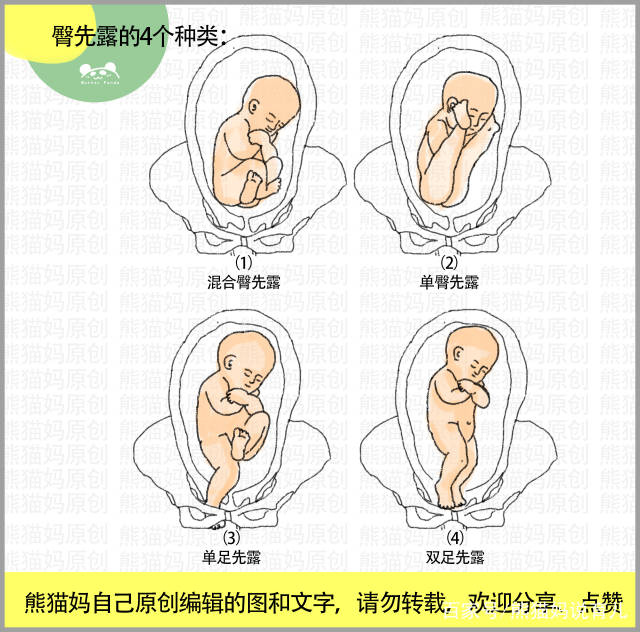 胎位不正11类型图:头先露,臀先露,横产式,斜产式,宝妈