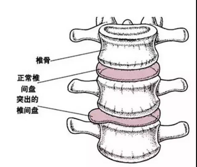 一直被"忽视"的3个症状,其实是腰椎间盘突出的信号,别