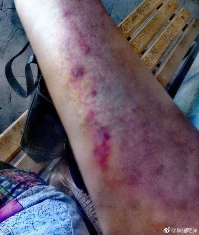 欠你一个冰河时代,还在微博上晒出了自己手上的淤青和受到性骚扰时的
