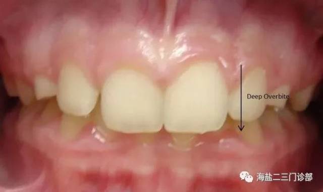 引起深覆合的原因?我们该如何矫正?
