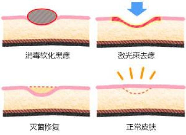 大部分小痣以混合痣组织象为,但是并不排除有神痣或者蓝痣的