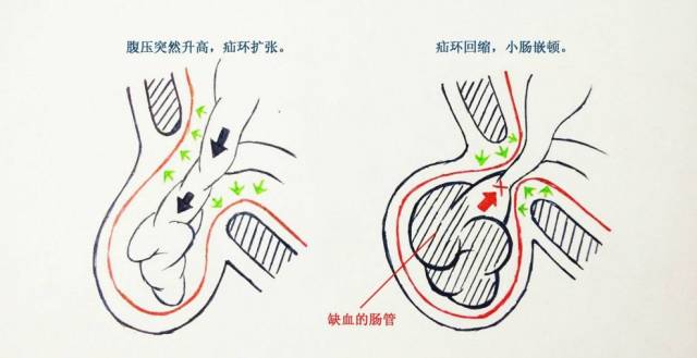 女孩也会得"疝气"?听听专家怎么说!