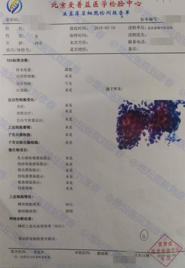 病例分享——宫颈上皮内瘤变cin3与宫颈癌的关系