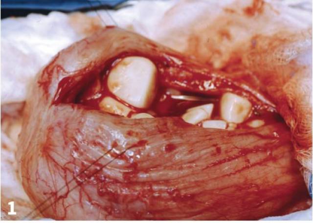 图1. 移除多个结石的膀胱切开术