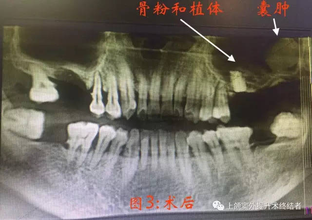 上颌窦内提病例分享