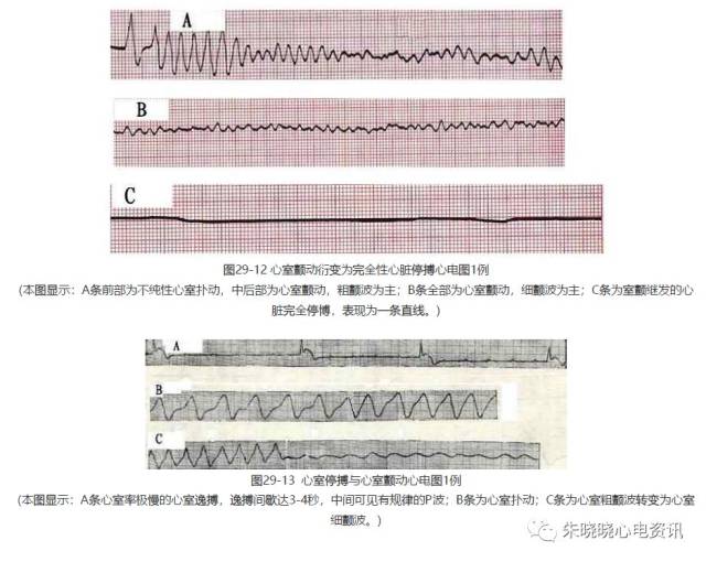 【临床实用心电图入门】 第二十九讲:心室扑动与颤动及濒死性心律失常