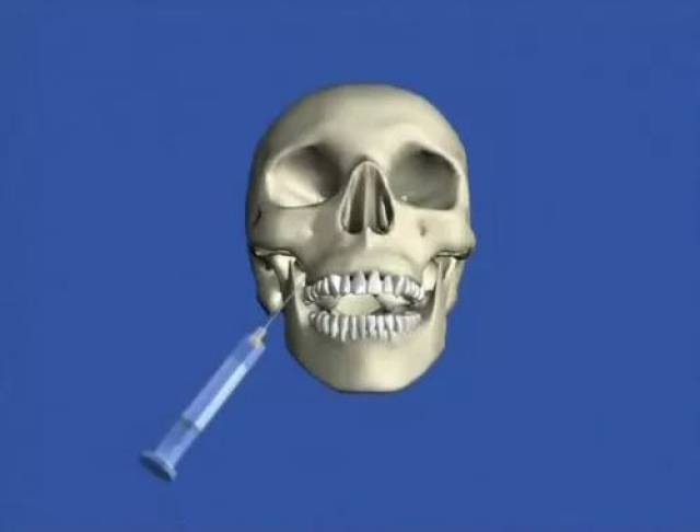 【临床技能】口腔神经阻滞麻醉技巧!
