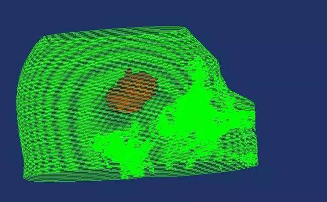 脑出血微创3d下定位七法